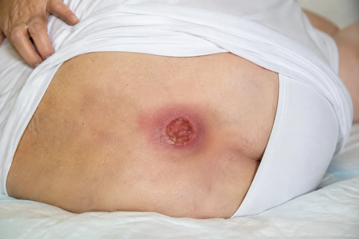 Pressure injury on a patient with limited mobility
